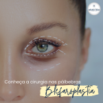 Conheça a Blefaroplastia (cirurgia nas pálpebras)