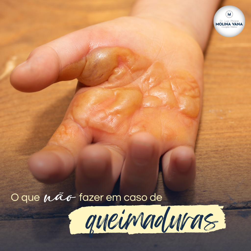Saiba como agir em caso de acidentes com queimadura - Dr. Molina
